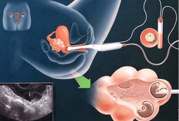 卵巢早衰患者的生育希望：了解试管婴儿技术