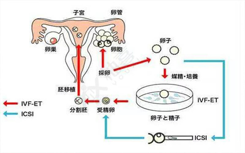 不孕不育问题及女性不孕的主要原因——子宫内膜异位症